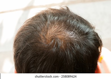 男性薄毛images Stock Photos Vectors Shutterstock