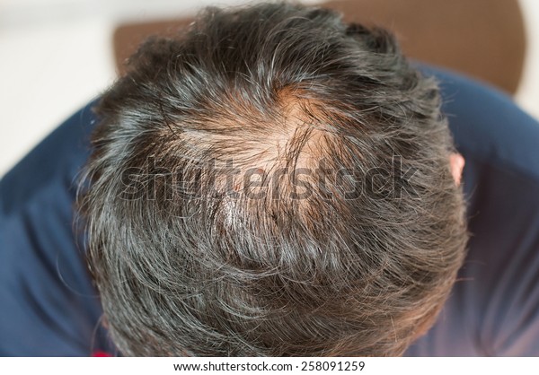 Hair Loss Thinning Hair Scalp Stock Photo Edit Now 258091259