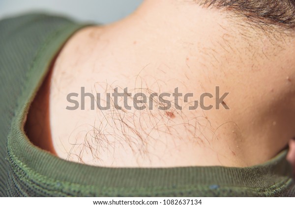 Hair On Back Man Moles On Stock Photo Edit Now 1082637134