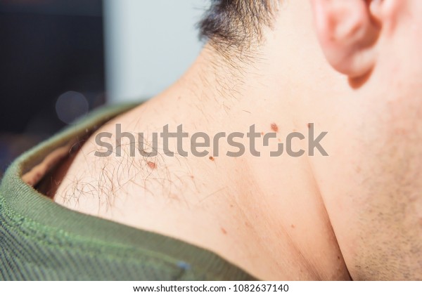 Hair On Back Man Moles On Stock Photo Edit Now 1082637140