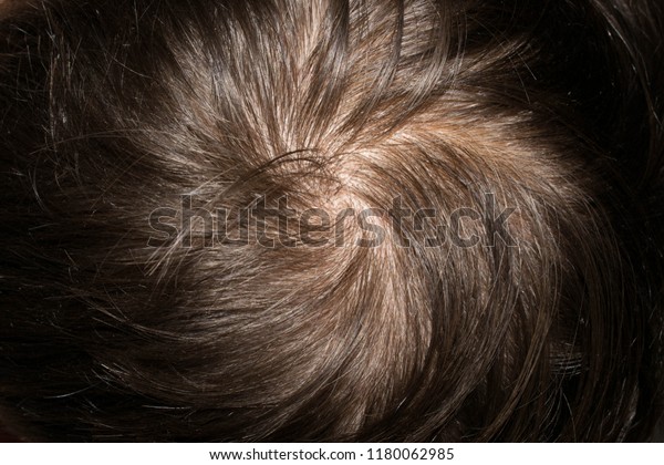 Hair On Head Man Thin Brittle Stock Photo Edit Now 1180062985
