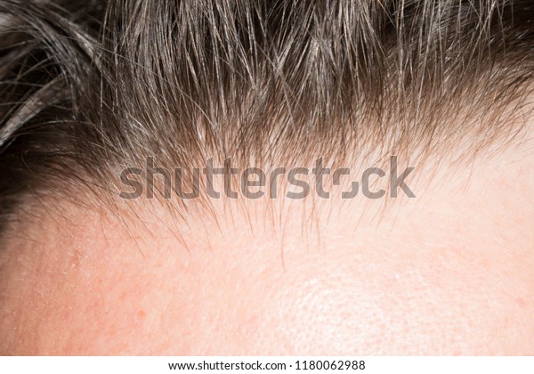 Hair On Head Man Thin Brittle Stock Photo Edit Now 1180062988