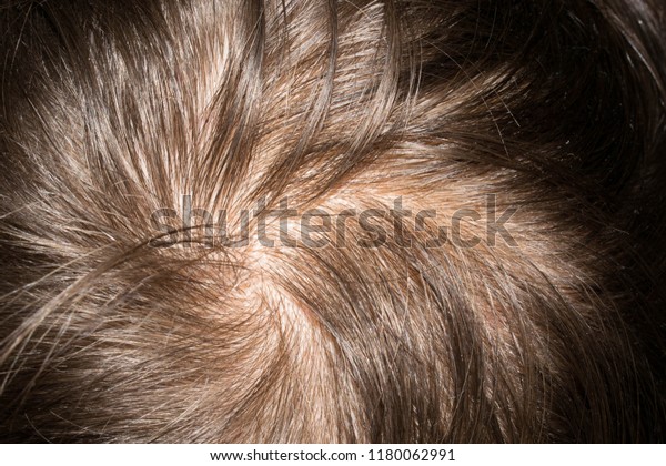 Hair On Head Man Thin Brittle Stock Photo Edit Now 1180062991