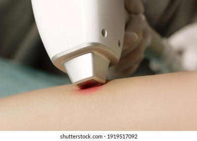 Hair Removal Cosmetology Procedure. Close-up Of Laser Epilation Maniple In Work