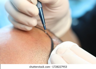 HAIR TRANSPLANT - FUE - DHI - SAPPPHIRE TECHNIQUES - Shutterstock ID 1728227953