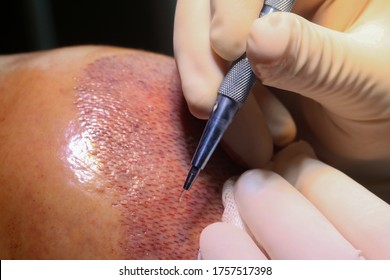 HAIR TRANSPLANT - FUE - DHI - SAPPPHIRE TECHNIQUES - Shutterstock ID 1757517398