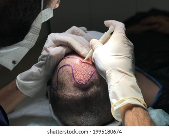 Hair Transplant In Medical Clinic