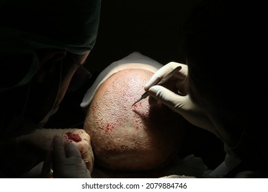 Hair Transplant Patient After The Operation