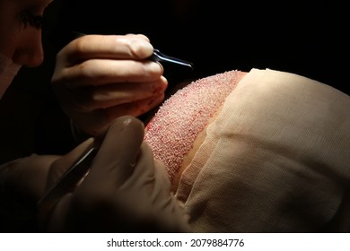 Hair Transplant Patient After The Operation