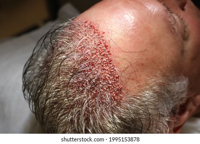 Hair Transplant Patient In Clinic