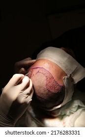 Hair Transplant Patient During And After The Surgery