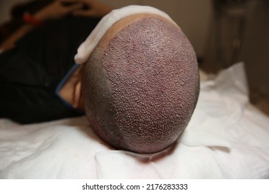 Hair Transplant Patient During And After The Surgery