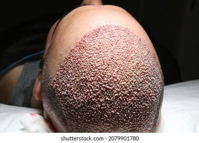 Hair Transplant Patient In The End Of The Operation