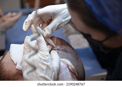 Hair Transplant Patient In The End Of The Operation
