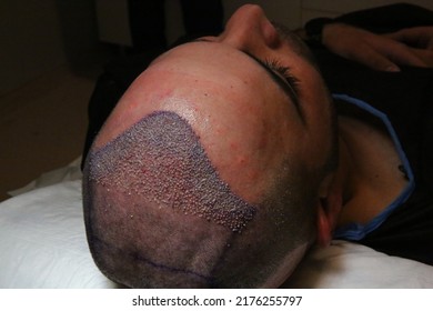 Hair Transplant Patient In The End Of The Surgery