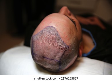 Hair Transplant Patient In The End Of The Surgery