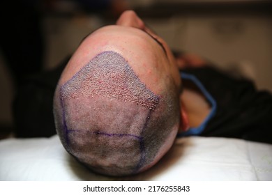 Hair Transplant Patient In The End Of The Surgery