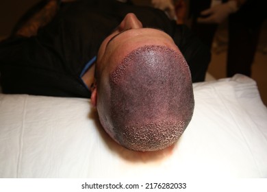 Hair Transplant Patient In The End Of The Surgery