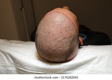 Hair Transplant Patient In The End Of The Surgery