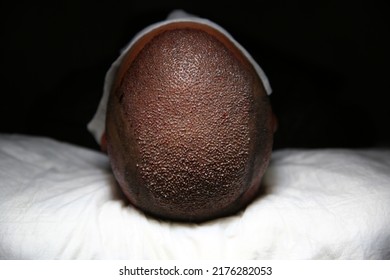 Hair Transplant Patient In The End Of The Surgery