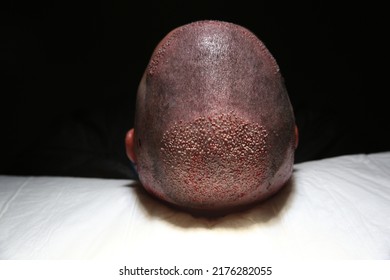 Hair Transplant Patient In The End Of The Surgery