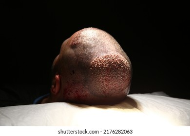 Hair Transplant Patient In The End Of The Surgery