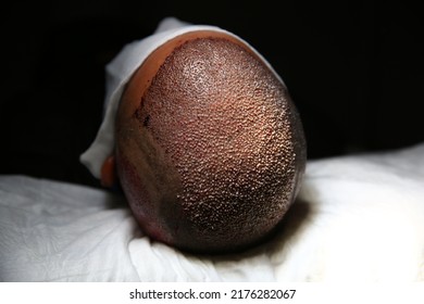 Hair Transplant Patient In The End Of The Surgery