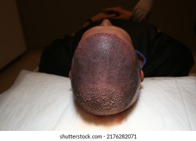 Hair Transplant Patient In The End Of The Surgery