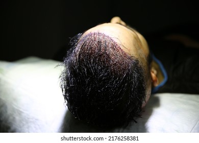 Hair Transplant Patient Post Operation, Hair Transplant Patient In The End Of The Operation