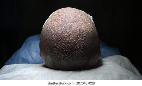 Hair Transplantation With Dhi Technique
