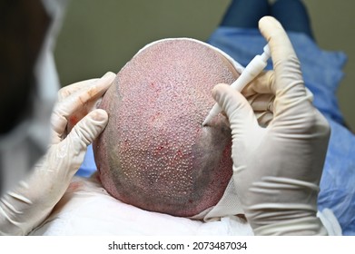 Hair Transplantation With Dhi Technique
