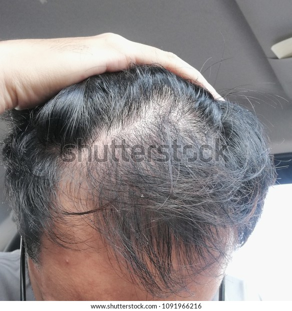 Hairloss Receding Hairline Healthcare Medical Stock Image