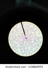 Hairy Cell Leukemia