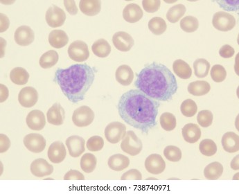 Hairy Cell Leukemia