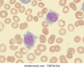 Hairy Cell Leukemia Variant