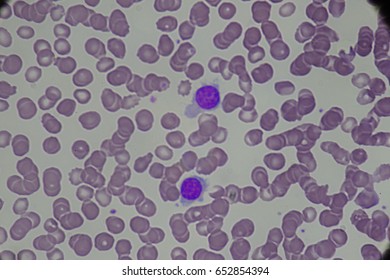 101 Hairy Cell Leukemia Images, Stock Photos & Vectors 