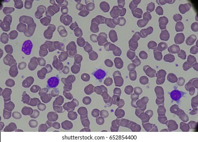 101 Hairy cell leukemia Images, Stock Photos & Vectors | Shutterstock