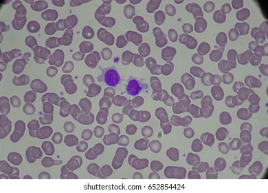 101 Hairy cell leukemia Images, Stock Photos & Vectors | Shutterstock