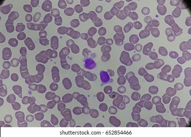 101 Hairy cell leukemia Images, Stock Photos & Vectors | Shutterstock