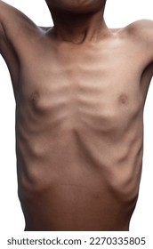 Half body portrait of a skinny asian boy stretching shows the ribs that line the body clear isolated on white background included clipping path.