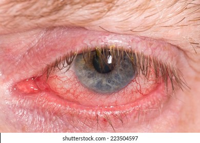Half closed red and irritated eye with blood vessels