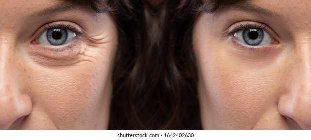 Half face of a girl before and after a rejuvination treatment for eye wrinkles and crow's feet