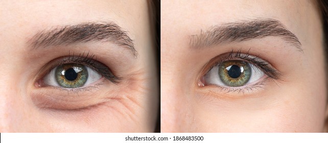 Half face of a girl before and after a rejuvination treatment.
