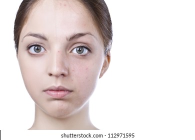 half of the face of the girl with spots and the second half of the face without spots