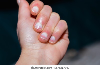 Unhealthy Fingernails High Res Stock Images Shutterstock