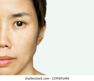 Half-face Portrait Young Asian Woman With Freckle Face Skin