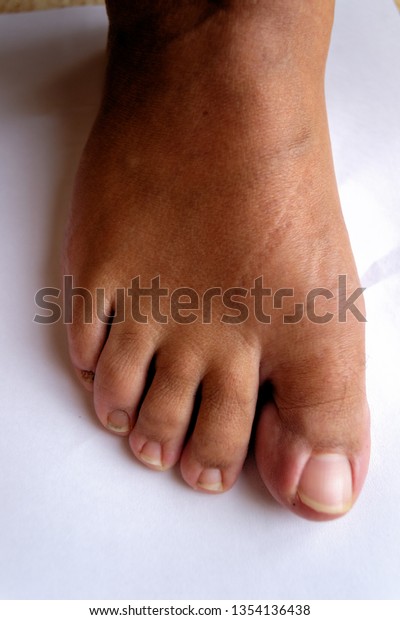 A HALLUX RIGIDUS ON FOOT