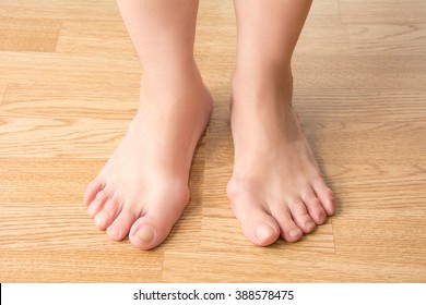 Hallux Valgus, Bunion In Foot.