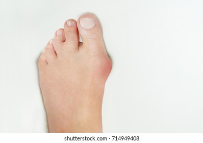 1,986 Hallux valgus Images, Stock Photos & Vectors | Shutterstock