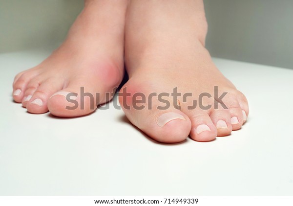 Hallux valgus,
bunion in foot on white
background